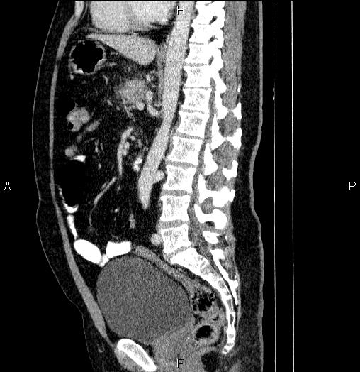 Acute pancreatitis (Radiopaedia 85390-101010 Sagittal C+ portal venous phase 55).jpg