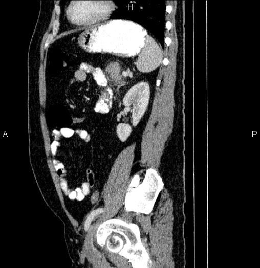 Acute pancreatitis (Radiopaedia 85390-101010 Sagittal C+ portal venous phase 73).jpg