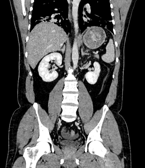 Acute pancreatitis (Radiopaedia 87428-103757 Coronal C+ portal venous phase 58).jpg