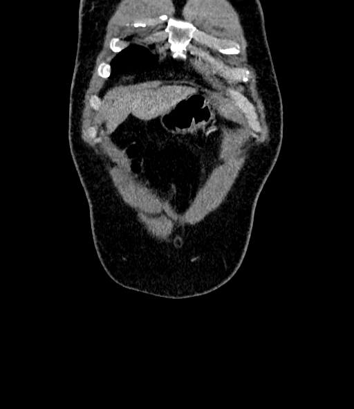 Acute pancreatitis (Radiopaedia 87428-103757 Coronal C+ portal venous phase 8).jpg