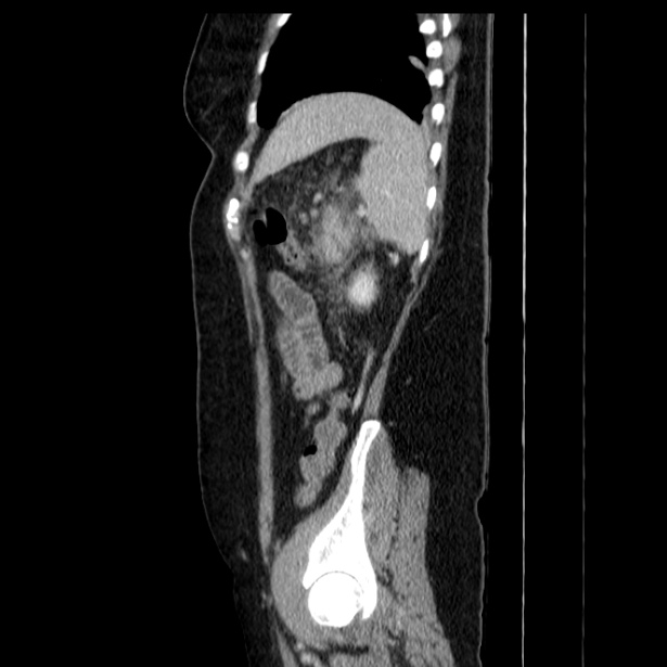 Acute pancreatitis - Balthazar C (Radiopaedia 26569-26714 Sagittal C+ portal venous phase 54).jpg