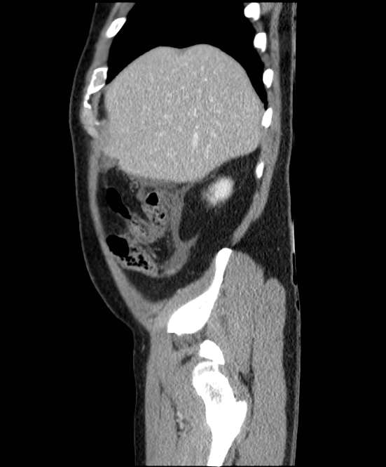 Acute pancreatitis - Balthazar E (Radiopaedia 23080-23110 Sagittal C+ portal venous phase 13).jpg