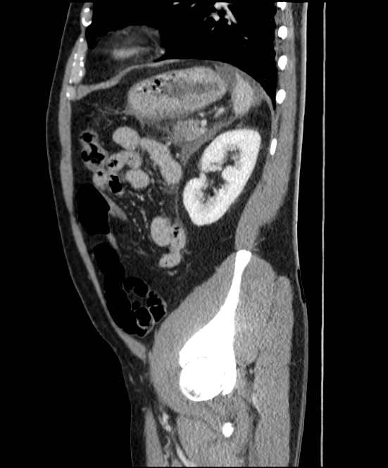 Acute pancreatitis - Balthazar E (Radiopaedia 23080-23110 Sagittal C+ portal venous phase 75).jpg