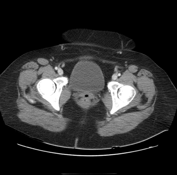 File:Acute pancreatitis - Balthazar E (Radiopaedia 29016-29377 Axial C+ portal venous phase 71).png