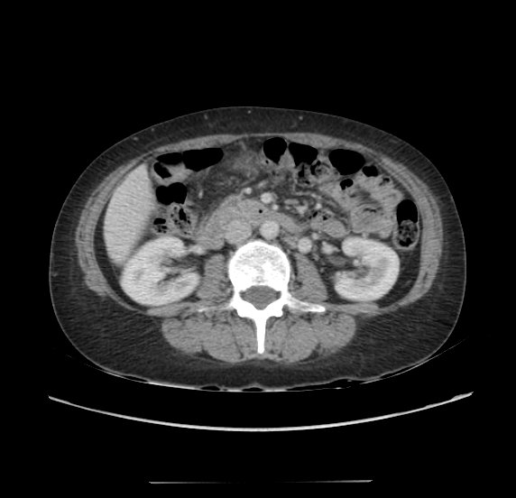 File:Acute pancreatitis - Balthazar E - post ERCP (Radiopaedia 27562-27772 Axial C+ portal venous phase 36).png