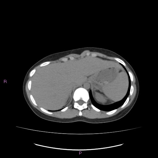 Acute pancreatitis secondary to stone at minor papilla and pancreatic divisum (Radiopaedia 76570-88333 Axial non-contrast 13).jpg