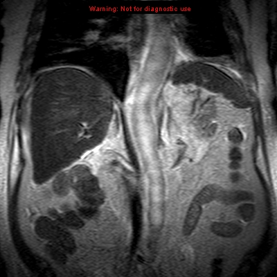 File:Acute pancreatitis with incidental pancreatic lipoma (Radiopaedia 10190-10732 Coronal T2 19).jpg