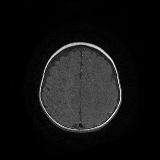 File:Acute phase of hemiconvulsion-hemiplegia epilepsy syndrome (Radiopaedia 29309-29745 Axial TOF angiography 1).jpg