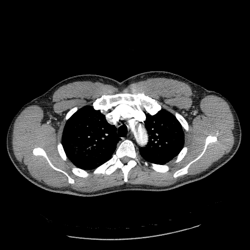 Acute segmental pulmonary emboli and pulmonary infarction (Radiopaedia 62264-70444 Axial C+ CTPA 33).jpg