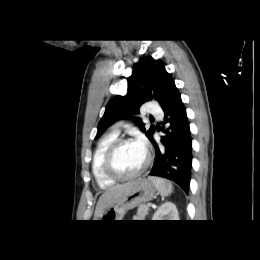 Acute segmental pulmonary emboli and pulmonary infarction (Radiopaedia 62264-70444 Sagittal C+ CTPA 45).jpg