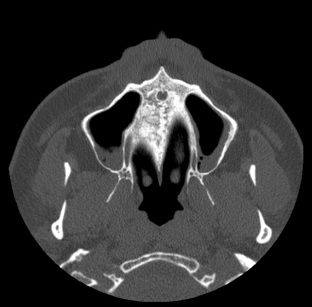 Acute sinusitis (Radiopaedia 23161-23215 Axial bone window 12).jpg