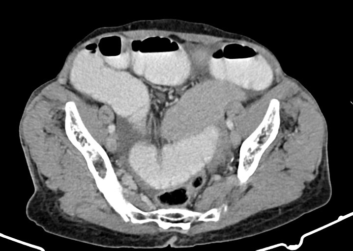 Acute small bowel (ileal) volvulus (Radiopaedia 71740-82139 Axial C+ portal venous phase 161).jpg