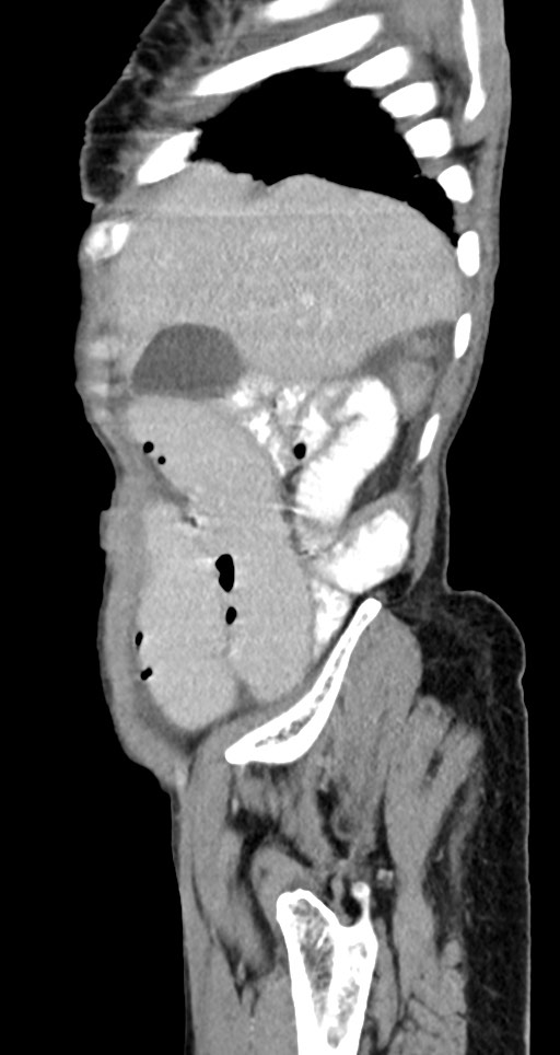 Acute small bowel (ileal) volvulus (Radiopaedia 71740-82139 Sagittal C+ portal venous phase 135).jpg