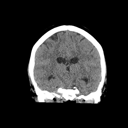 Acute subarachnoid hemorrhage and accessory anterior cerebral artery (Radiopaedia 69231-79008 Coronal non-contrast 40).jpg