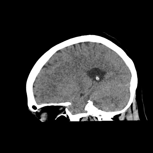 Acute subarachnoid hemorrhage and accessory anterior cerebral artery (Radiopaedia 69231-79008 Sagittal non-contrast 38).jpg