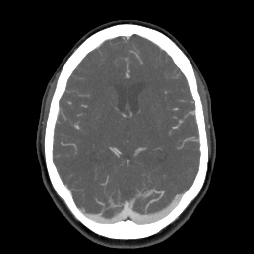 Acute subarachnoid hemorrhage and accessory anterior cerebral artery (Radiopaedia 69231-79009 D 35).jpg