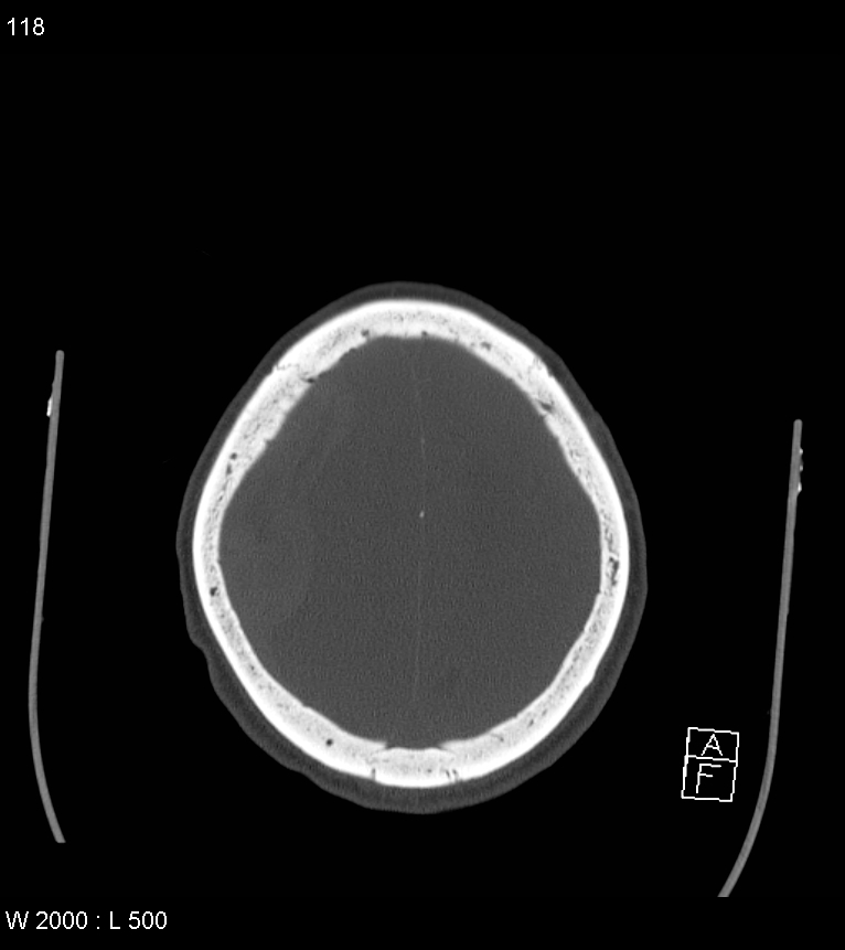 Acute subdural hematoma with myelofibrosis (Radiopaedia 52582-58494 Axial bone window 59).jpg