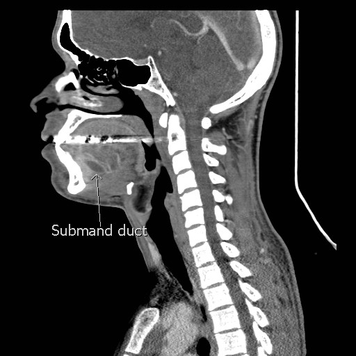 File:Acute submandibular sialadenitis secondary to ductal stone (Radiopaedia 27999-28267 Sagittal C+ delayed 3).jpg