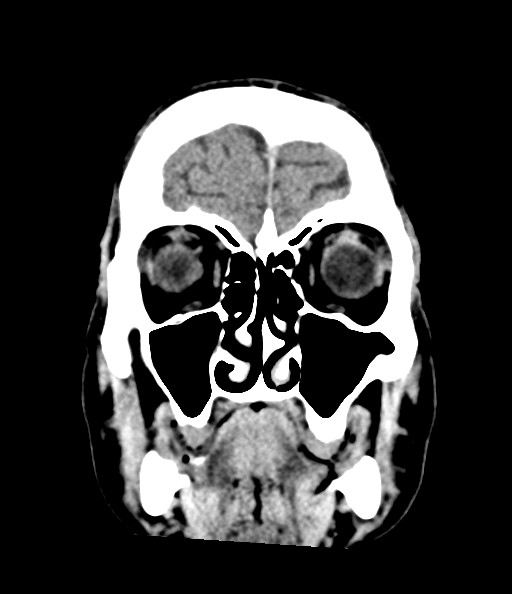 Acute superior cerebellar artery territory infarct (Radiopaedia 84104-99359 Coronal non-contrast 27).jpg