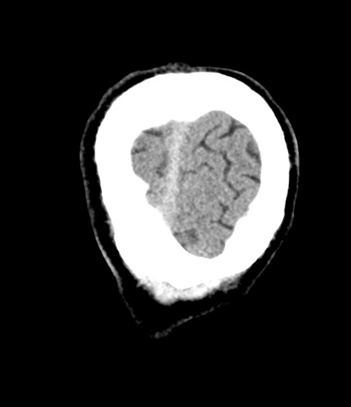 Acute superior cerebellar artery territory infarct (Radiopaedia 84104-99359 Coronal non-contrast 80).jpg