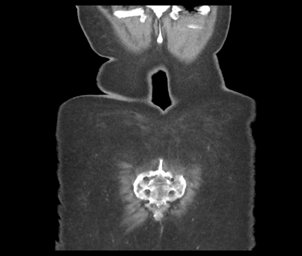 Acute superior mesenteric artery occlusion (Radiopaedia 43926-47418 Coronal C+ portal venous phase 49).png
