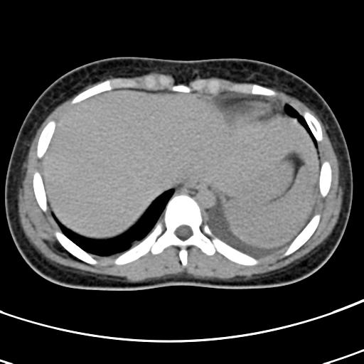 File:Acute suppurative pyelonephritis (Radiopaedia 18306-18147 Axial renal excretory phase 3).jpg