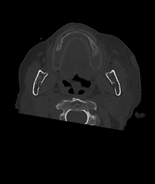 Acute traumatic subdural hematoma (Radiopaedia 82921-97257 Axial bone window 111).jpg