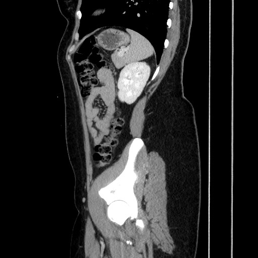 Acute uncomplicated appendicitis (Radiopaedia 73704-84499 Sagittal C+ portal venous phase 151).jpg