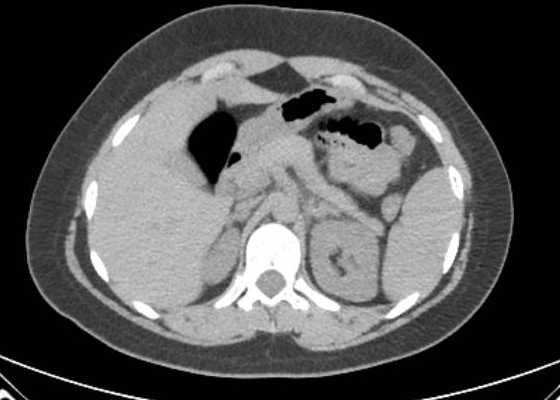 Acute unilateral nonhemorrhagic adrenal infarction (Radiopaedia 67560-76957 Axial non-contrast 35).jpg