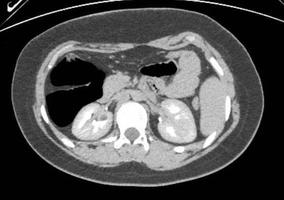 Acute unilateral nonhemorrhagic adrenal infarction (Radiopaedia 67560-76957 Axial renal excretory phase 69).jpg