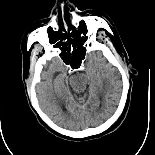 Acute vertebrobasilar ischemic infarction (Radiopaedia 25220-25473 Axial non-contrast 22).jpg