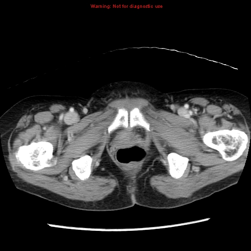 Adenocarcinoma of the colon (Radiopaedia 8191-9039 Axial liver window 77).jpg