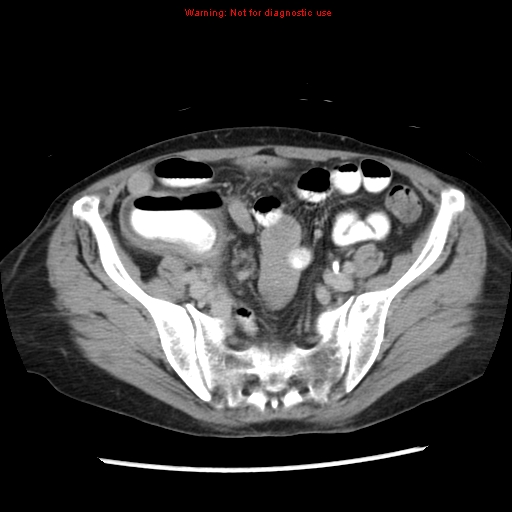 File:Adenocarcinoma of the colon (Radiopaedia 8191-9039 Axial renal excretory phase 43).jpg