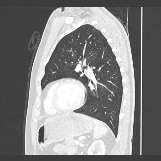 Adenocarcinoma of the lung (Radiopaedia 59871-67325 Sagittal lung window 71).jpg