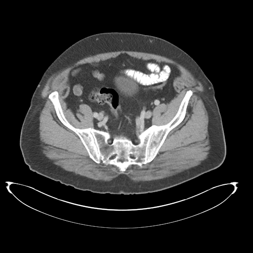 File:Adenocarcioma of rectum- T1 lesion (Radiopaedia 36921-38547 Axial C+ portal venous phase 70).png