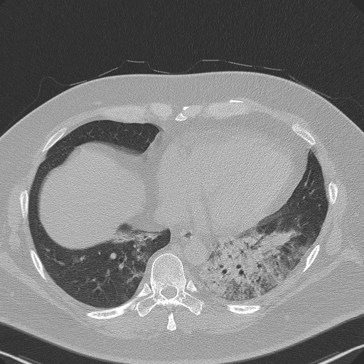 Adenoid cystic carcinoma of the trachea (Radiopaedia 49042-54137 Axial lung window 257).jpg