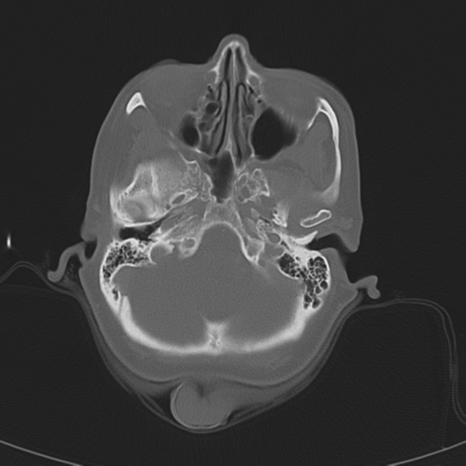 Adenoid cystic tumor of palate (Radiopaedia 46980-51518 Axial bone window 17).png