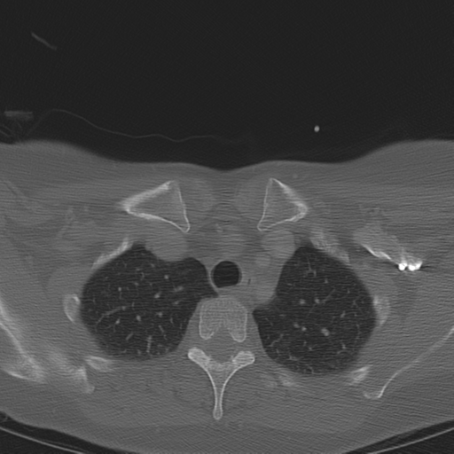 Adenoid cystic tumor of palate (Radiopaedia 46980-51518 Axial bone window 74).png