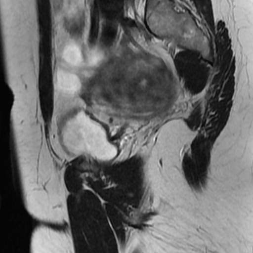 File:Adenoma malignum of cervix (Radiopaedia 66441-75705 Sagittal T2 4).jpg