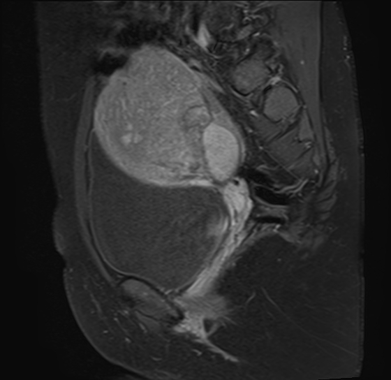 File:Adenomyosis - ovarian endometriomas (Radiopaedia 67031-76350 Sagittal T1 C+ fat sat 9).jpg