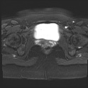 File:Adenomyosis and endometriotic cysts (Radiopaedia 82300-96367 Axial DWI 2).jpg