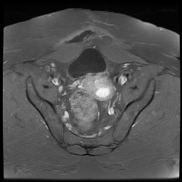 File:Adenomyosis within a didelphys uterus (Radiopaedia 70175-80215 Axial T1 C+ fat sat 25).jpg