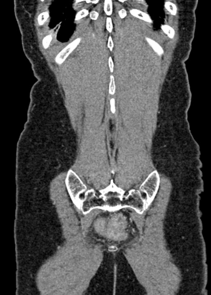 Adhesional small bowel obstruction (Radiopaedia 48397-53305 Coronal C+ portal venous phase 311).jpg