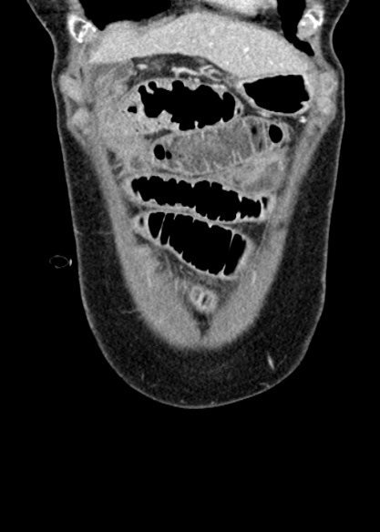 Adhesional small bowel obstruction (Radiopaedia 48397-53305 Coronal C+ portal venous phase 55).jpg