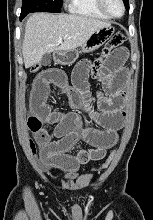 Adhesional small bowel obstruction (Radiopaedia 58900-66131 Coronal C+ portal venous phase 96).jpg