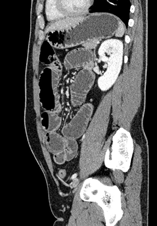 Adhesional small bowel obstruction (Radiopaedia 58900-66131 Sagittal C+ portal venous phase 167).jpg