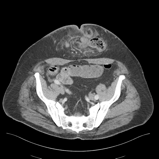 Adhesions within abdominal wall hernia (Radiopaedia 58283-65394 Axial C+ portal venous phase 66).png