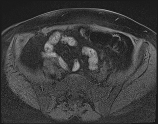 File:Adnexal multilocular cyst (O-RADS US 3. O-RADS MRI 3) (Radiopaedia 87426-103754 Axial 215).jpeg
