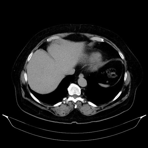 Adrenal cortical carcinoma (Radiopaedia 64017-72769 Axial C+ delayed 11).jpg