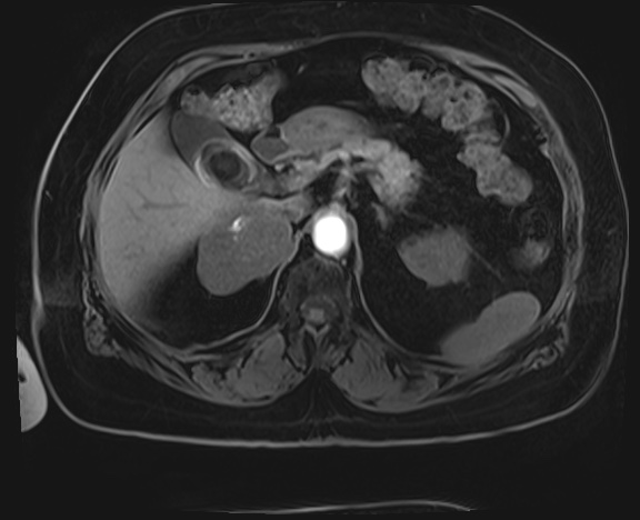 Adrenal cortical carcinoma (Radiopaedia 64017-72770 Axial T1 C+ fat sat 9).jpg